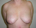 Patient # 94881 Before Photo # 1